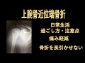 上腕骨頚部(近位端)骨折の日常生活における注意点-骨折を長引かせないための生活方法の工夫-