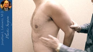 6 Weeks Post Gynecomastia 4D Chest Contouring, The Long Island Vaserlipo Center, NY By Dr. Lebowitz