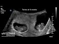 Scan of the week twins at 9 weeks gestation