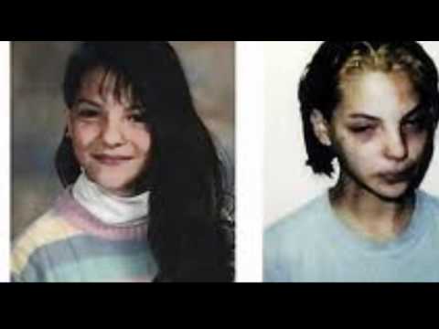 Crystal Meth Before & After and its Devastating Effects