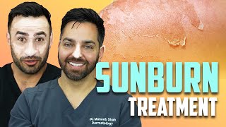 SUNBURN  How To Treat a Sunburn like a Dermatologist