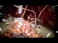 Tennis racquet bladder neck reconstruction in robotic prostatectomy