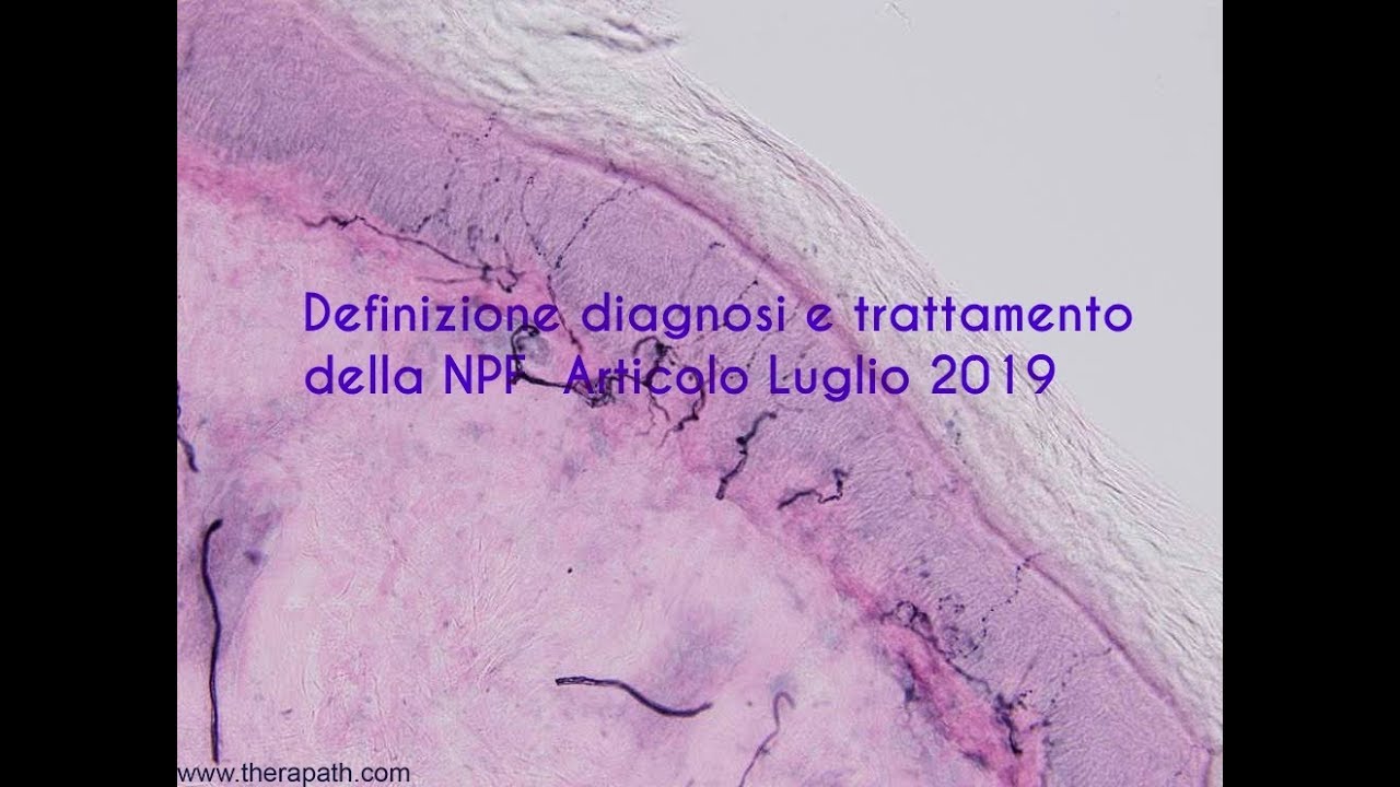 Definizione, diagnosi e trattamento della neuropatia