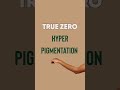 Top Laser Hair Removal Clinic in Coimbatore | What to Expect with True Zero #laserhairremoval
