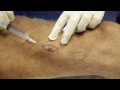 Skin Cancer Surgery - Basal Cell Carcinoma Excision on the Leg