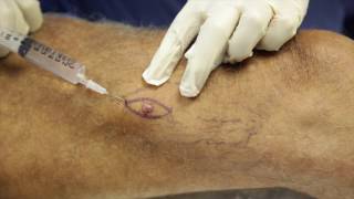 Skin Cancer Surgery - Basal Cell Carcinoma Excision on the Leg