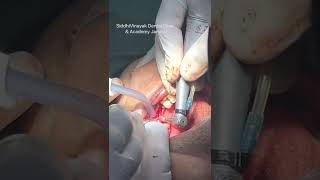 Dental Implant procedure- from Initial drill to the last. NORRIS IMPLANT