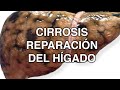 La Cirrosis Hepática