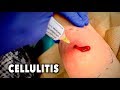 Abscess with cellulitis we had to drain it  dr paul