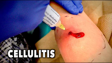 ABSCESS WITH CELLULITIS... (We had to drain it) | Dr. Paul