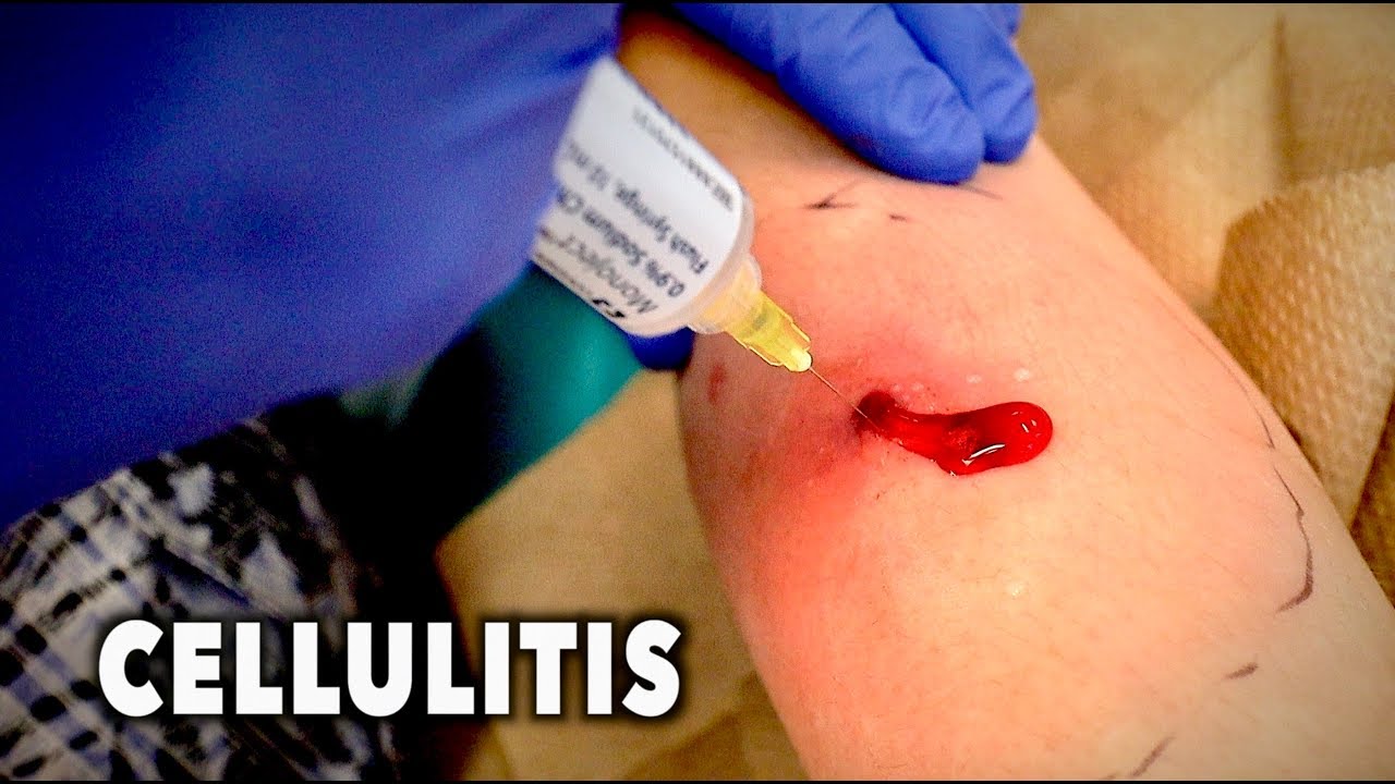 dog bite cellulitis treatment