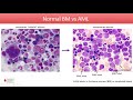 Acute Myeloid Leukemia - Diagnosis and Treatment in 2020