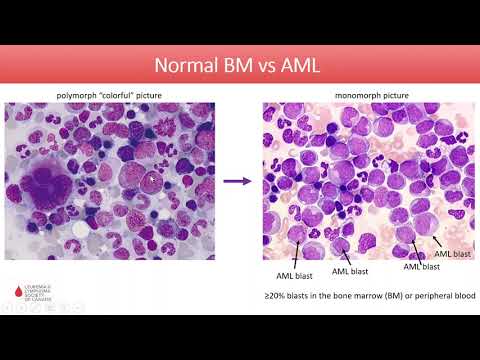 Acute Myeloid Leukemia - Diagnosis and Treatment in 2020