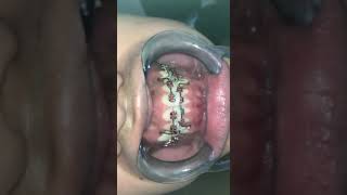 closing extraction spaces on braces using closing loops.