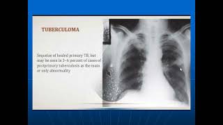 Radiological Manifestations of Pulmonary Tuberculosis