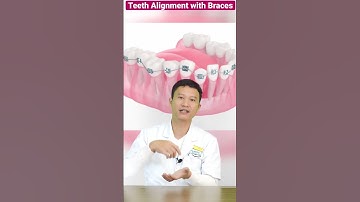 Qúa Trình Niềng Răng Mắc Cài Kim Loại | Nha Khoa Minh Châu