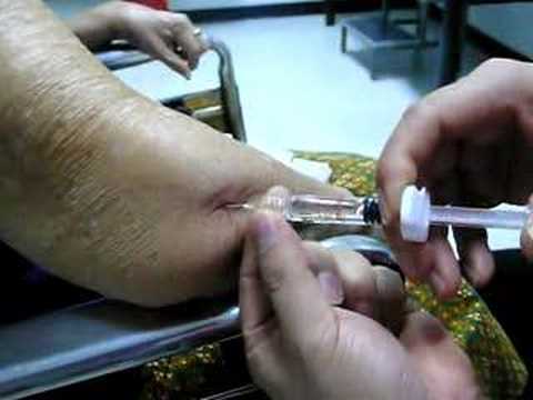 Elbow injection viscosupplementation ปวดข้อศอก ข้อเสื่อม