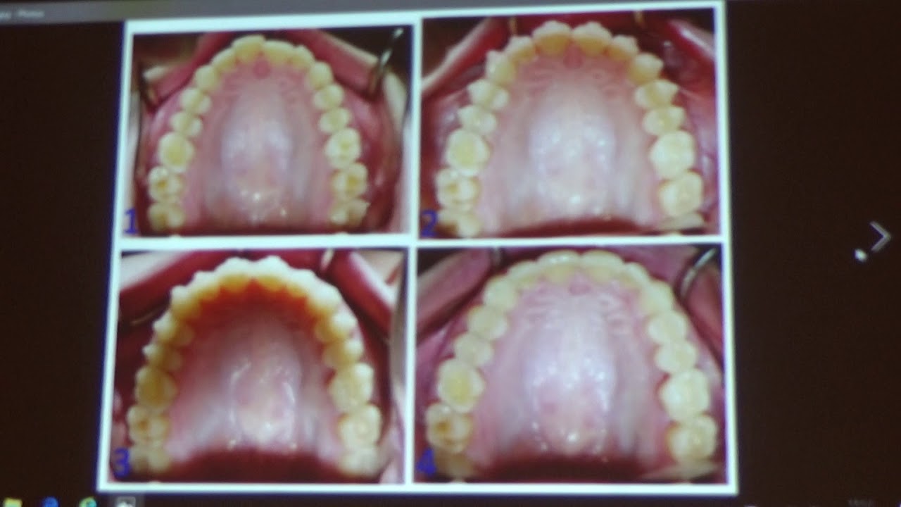 Invisalign training course 1 00023 YouTube