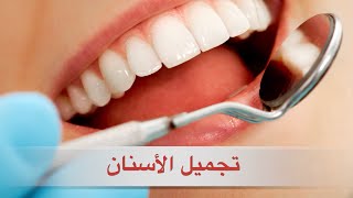 أنواع تجميل الأسنان