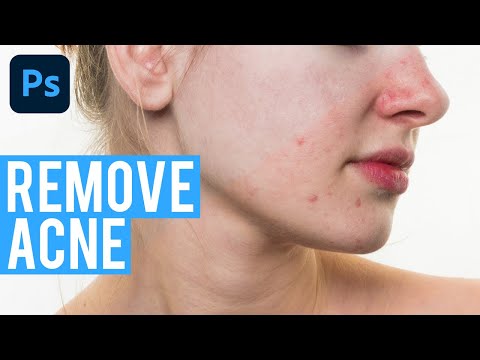 Adobe Photoshop - Remove Acne