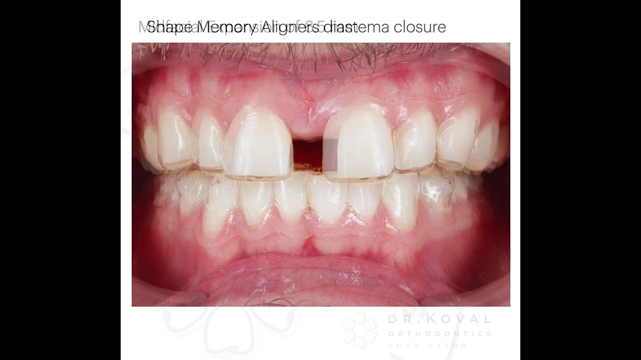 MARPE and Shape Memory Aligners treatment