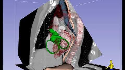 Mid-Esophageal Bicaval Imaging Plane in TEE - Standard View