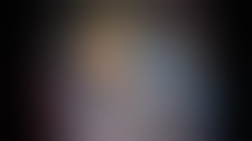 Supracapsular glued iol Soosan Jacob with audio 4mins video