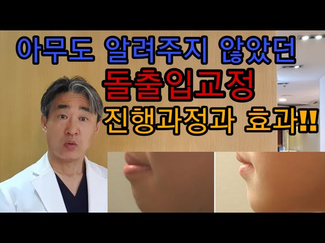 😍😍기대를 저버리지 않은 돌출입 교정. 드디어 변신 성공^^!!