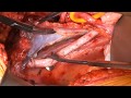 female Radical cystectomy with ileum conduit (anterior exenteration + Bricker`s operation)