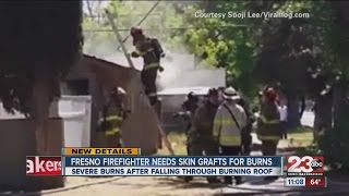 Fresno firefighter needs skin grafts for burns