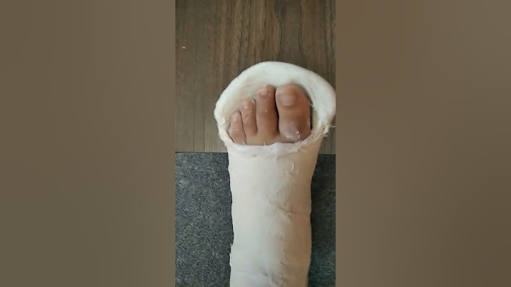 убрали гипс