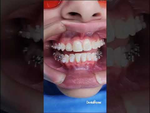 Ortodoncia con Brackets Damon