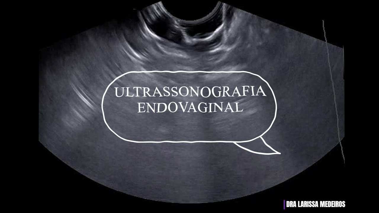 CISTO DE NABOTH Ultrassom endovaginal YouTube CISTO DE NABOTH Ultrassom endovaginal YouTube