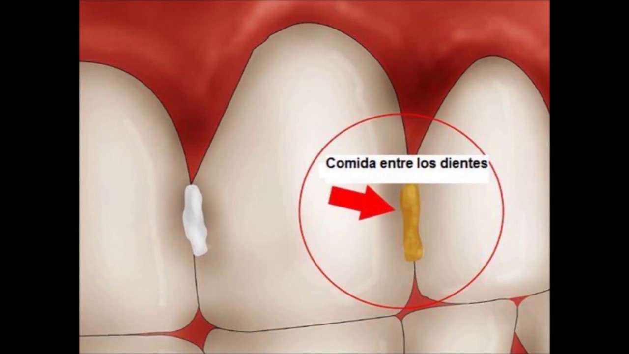 Uno Salud Dental - Doctor En Casa (GINGIVITIS) sonrisal serve para dor de cabeça