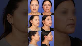 Mini Face Lift
