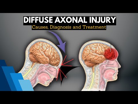 Diffuse Axonal Injury, Causes, Signs and Symptoms, Diagnosis and Treatment.