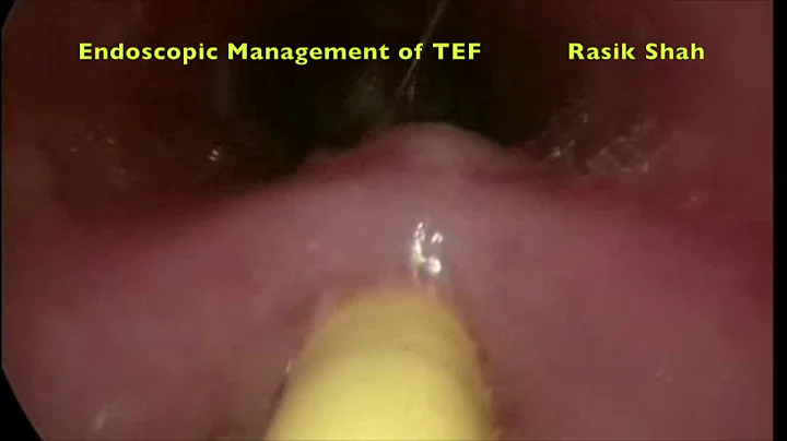 Endoscopic management of tracheo-esophage...  fist...