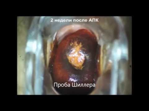 Плоская кондилома шейки матки. АПА.