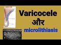 Varicocele and microlithiasis.