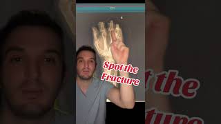 Can You Spot The Subtle Fracture In This X-Ray?