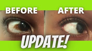 11 month update How to get rid of brown spot on eye| Pigment| Freckle| Pterygium| Conjunctival Nevus
