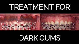 Complete Guide On How To Get Rid Of Black Gums Updated Complete Guide On How To Get Rid Of Black Gums Updated
