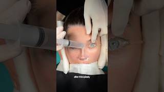 Thick skin rhinoplasty requires strategy—not just surgery. #barbienose