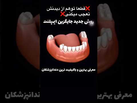 پروتز پارسیل متحرک دندان مصنوعی