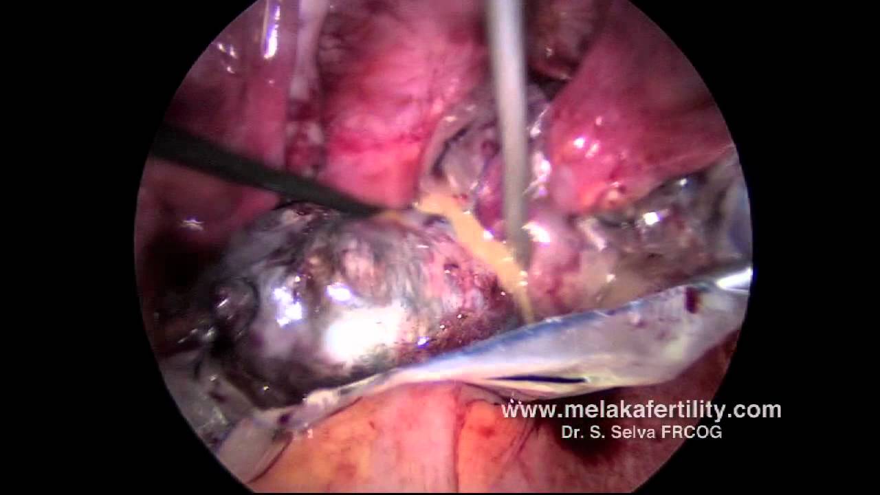 Ooforoplastia por video (cisto dermoide) / Video oophoroplasty (dermoid  cyst) 