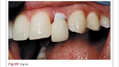 Bench Mastery: Custom shade matching in an anterior implant case