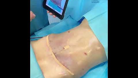 TRỌN COMBO HÚT MỠ BỤNG CĂNG DA DỜI RỐN | BÁC SĨ TRỊNH QUANG ĐẠI