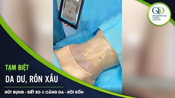 TRỌN COMBO HÚT MỠ BỤNG CĂNG DA DỜI RỐN | BÁC SĨ TRỊNH QUANG ĐẠI