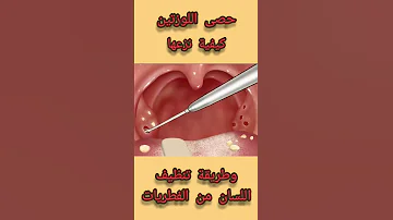 حصى اللوزتين علاجها وطريقة تنظيف اللسان من الفطريات 