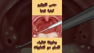 #حصى اللوزتين -علاجها وطريقة تنظيف اللسان من الفطريات